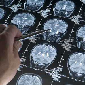 Treating Dementia With Hemp